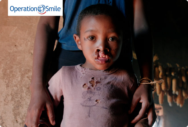 Operation Smile